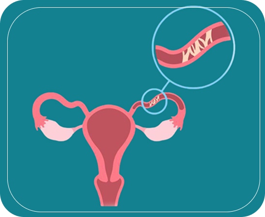 What is a Blocked Fallopian Tube?