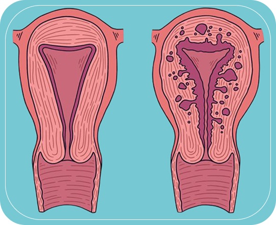 What is Adenomyosis?