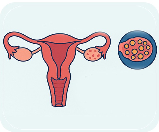What is PCOS?