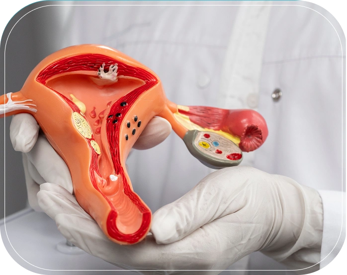 Causes & Risk Factors of PCOS